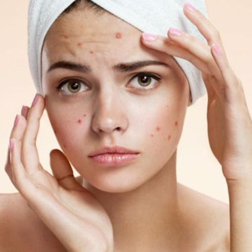 acne treatment service 500x500 1